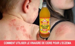 Utilisez le vinaigre de cidre pour traiter l’eczéma, c’est incroyablement efficace