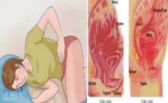Comprendre l'Endométriose : Symptômes, Diagnostic et Signes à Surveiller