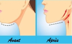 Le double menton : Que faire pour l'enlever ?