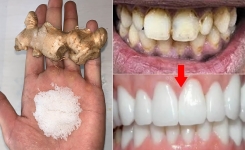 Le gingembre et le sel permettent de blanchir les dents : voici comment les utiliser