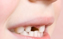 Pourquoi Vous Devriez Conserver les Dents de Lait de Vos Enfants : Les Dentistes Expliquent
