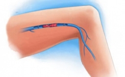 Important à Savoir : Symptômes et remèdes d’une thrombose veineuse dans les jambes …