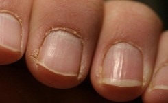 Leuchonychie : Ces Taches Blanches sur les Ongles ne Sont Pas un Manque de Calcium !