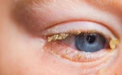 Croûte jaune sur les yeux le matin : causes, solutions et remèdes naturels