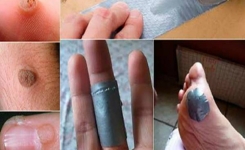 La meilleure astuce pour supprimer les verrues !