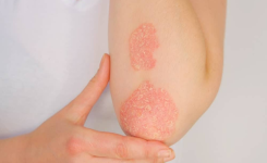 L’huile qui combat l’acné, l’eczéma et le psoriasis mieux que tout