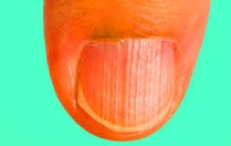 Ongles striés : ce qu’ils révèlent sur votre santé