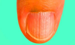 Ongles striés : ce qu’ils révèlent sur votre santé