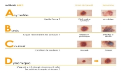 Comment surveiller ses grains de beauté