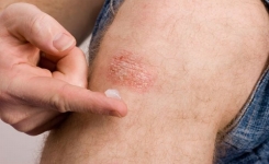 Comment traiter naturellement le psoriasis