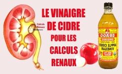 Moyens faciles d’utiliser le vinaigre de cidre pour les calculs rénaux