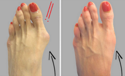 Comment se débarrasser l’hallux valgus (oignons de pieds) naturellement!