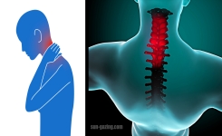 Comment soulager de la raideur et la douleur de la nuque ?