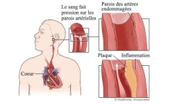 L’hypertension: Le tueur silencieux, 7 conseils pour la guérir naturellement