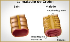 Maladie de Crohn : un champignon fait-il toute la différence ?