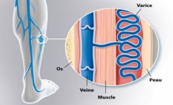 Le traitement naturel le plus efficace contre les varices